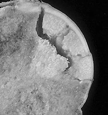 AAOS & ABOS Orthopedic MCQs (Set 5): Spine, Arthroplasty & Pediatric Cases | 2026 Board Prep