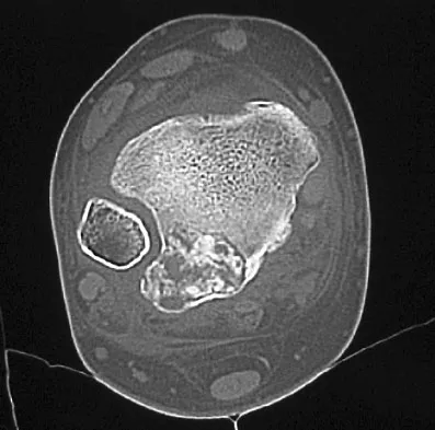General Orthopedics Board Review 2026: High-Yield MCQs (Set 6) - Figure 44