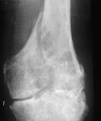 AAOS Orthopedic MCQs (Set 8): Spinal Pathology, Adult Reconstruction & Upper Extremity Trauma | 2026 Board Review