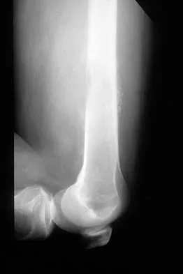 General Orthopedics Board Review 2026: High-Yield MCQs (Set 8) - Figure 45