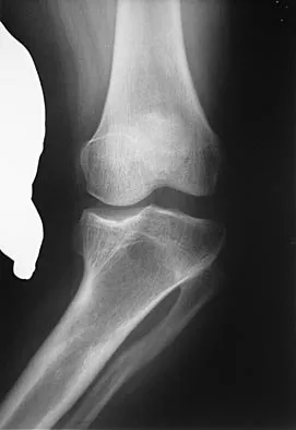 AAOS Orthopedic MCQs (Set 1): Hip Fractures & Arthroplasty | ABOS Board Review 2004