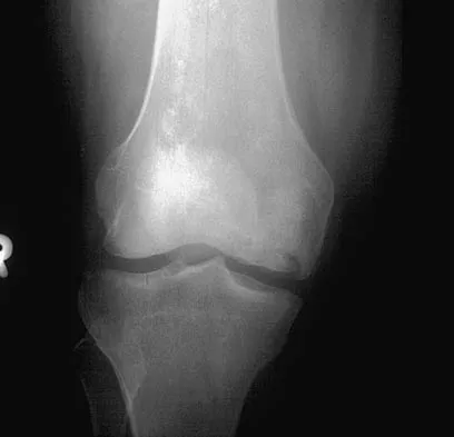 AAOS & ABOS Orthopedic MCQs (Set 2): Hip Fractures & Arthroplasty | Board Prep