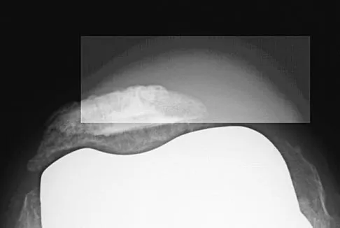 Hip Board Review 2004: High-Yield MCQs (Set 2) - Figure 6