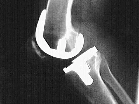 Hip Board Review 2004: High-Yield MCQs (Set 2) - Figure 9