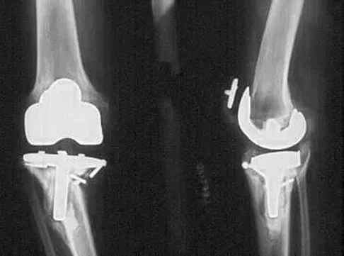 AAOS Hip MCQs (Set 3): Femoral Neck Fractures & Arthroplasty | ABOS Board Review