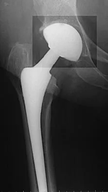 AAOS & ABOS Board Review (Set 4): Proximal Femur Fractures & Hip Dislocations MCQs