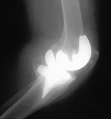 Hip Board Review 2004: High-Yield MCQs (Set 4) - Figure 5