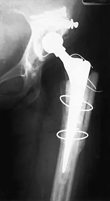 AAOS & ABOS Orthopedic Hip MCQs (Part 1): Fractures, Arthroplasty & Anatomy | 2026 Review