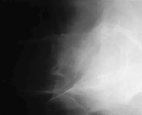 Hip 2026 MCQs: Board Review Questions & Answers (Part 1) - Figure 39