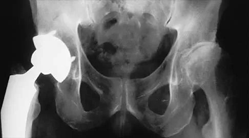 Hip 2026 MCQs: Board Review Questions & Answers (Part 1) - Figure 43