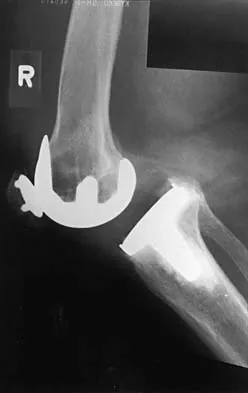 Hip 2026 MCQs: Board Review Questions & Answers (Part 1) - Figure 63