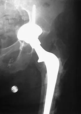 Hip 2026 MCQs: Board Review Questions & Answers (Part 2) - Figure 31