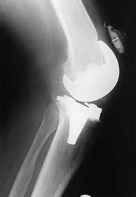 Hip 2026 MCQs: Board Review Questions & Answers (Part 2) - Figure 35