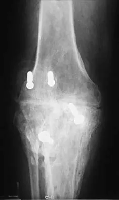 Hip 2026 MCQs: Board Review Questions & Answers (Part 2) - Figure 65