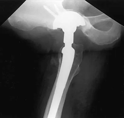 Hip 2026 MCQs: Board Review Questions & Answers (Part 2) - Figure 71