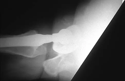 AAOS Hip MCQs (Part 4): Proximal Femur Fractures & Arthroplasty | 2026 Board Review