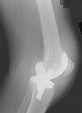 Hip & Knee Reconstruction 2007 Practice Questions: Set 1 (Solved) - Figure 13