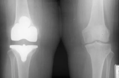 Hip & Knee Reconstruction 2007 Practice Questions: Set 1 (Solved) - Figure 15