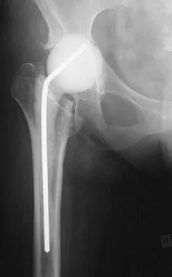 Hip & Knee Reconstruction 2007 Practice Questions: Set 1 (Solved) - Figure 17