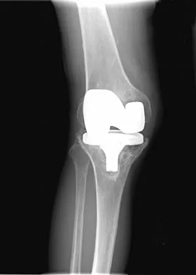 Hip & Knee Reconstruction 2007 Practice Questions: Set 1 (Solved) - Figure 18