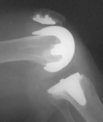 Hip & Knee Reconstruction 2007 Practice Questions: Set 1 (Solved) - Figure 26