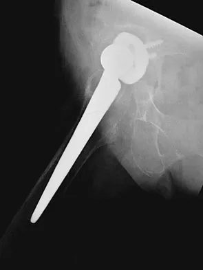 Hip & Knee Reconstruction 2007 Practice Questions: Set 1 (Solved) - Figure 28