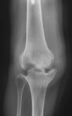 Hip & Knee Reconstruction 2007 Practice Questions: Set 1 (Solved) - Figure 3