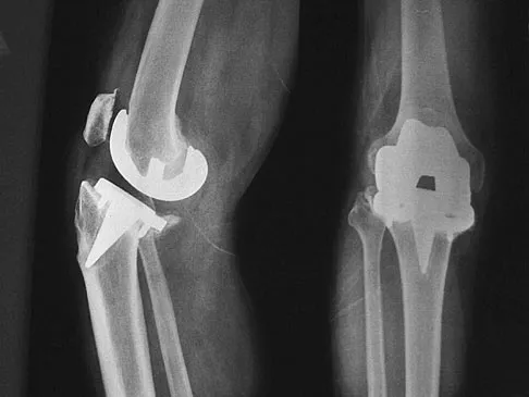 Hip & Knee Reconstruction 2007 Practice Questions: Set 1 (Solved) - Figure 32