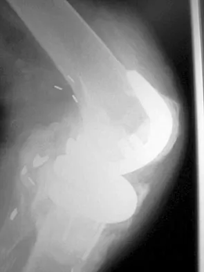 Hip & Knee Reconstruction 2007 Practice Questions: Set 1 (Solved) - Figure 6