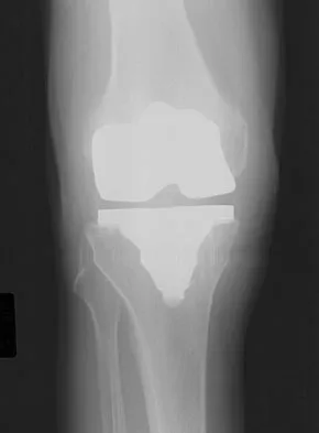 Hip & Knee Reconstruction 2007 Practice Questions: Set 1 (Solved) - Figure 7