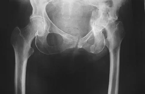 Hip & Knee Reconstruction Board Review 2007: High-Yield MCQs (Set 2) - Figure 22
