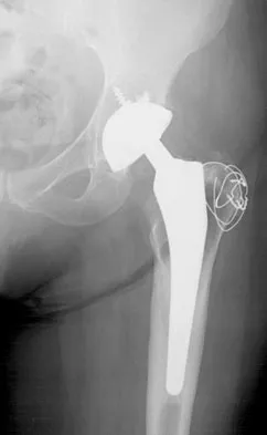 Hip & Knee Reconstruction Board Review 2007: High-Yield MCQs (Set 2) - Figure 24