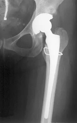Hip & Knee Reconstruction Board Review 2007: High-Yield MCQs (Set 2) - Figure 25