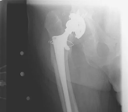 Hip & Knee Reconstruction Board Review 2007: High-Yield MCQs (Set 2) - Figure 5