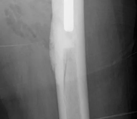 Hip & Knee Reconstruction Board Review 2007: High-Yield MCQs (Set 2) - Figure 6