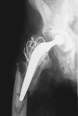 Hip & Knee Reconstruction 2007 Practice Questions: Set 3 (Solved) - Figure 10