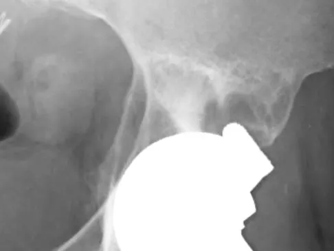Hip & Knee Reconstruction 2007 Practice Questions: Set 3 (Solved) - Figure 13