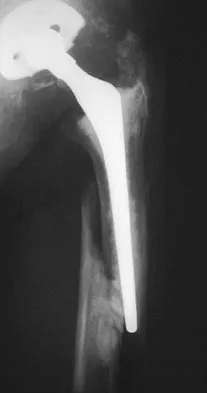 Hip & Knee Reconstruction 2007 Practice Questions: Set 3 (Solved) - Figure 16