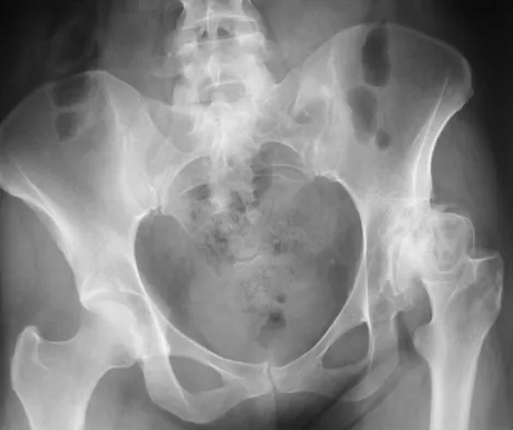 Hip & Knee Reconstruction 2007 Practice Questions: Set 3 (Solved) - Figure 4