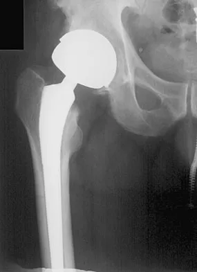 Hip & Knee Reconstruction 2007 Practice Questions: Set 3 (Solved) - Figure 5