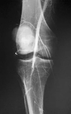 Hip & Knee Reconstruction 2007 Practice Questions: Set 3 (Solved) - Figure 6