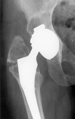 Hip & Knee Reconstruction 2007 Practice Questions: Set 3 (Solved) - Figure 9