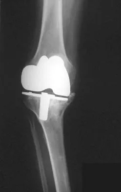 Hip & Knee Reconstruction Board Review 2007: High-Yield MCQs (Set 4) - Figure 14