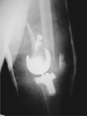 Hip & Knee Reconstruction Board Review 2007: High-Yield MCQs (Set 4) - Figure 16