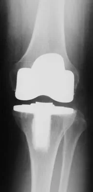 Hip & Knee Reconstruction Board Review 2007: High-Yield MCQs (Set 4) - Figure 17