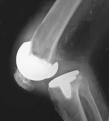 AAOS Orthopedic Hip & Knee MCQs (Part 1): 2026 Board Review Questions