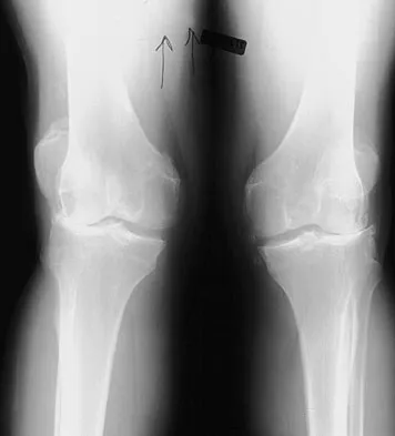 Master Orthopedic Hip & Knee (Part 4): THA, TKA, & ACL Reconstruction MCQs for AAOS & ABOS