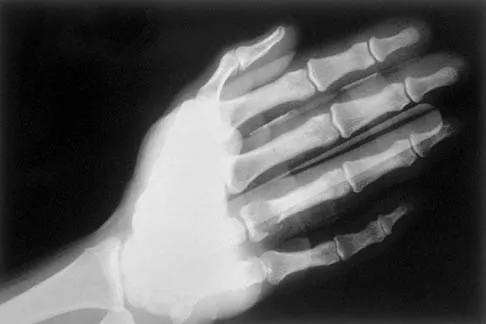 Orthopedic Basic MCQs (Part 4): Long Bone Trauma & Biomechanics | AAOS & ABOS Review