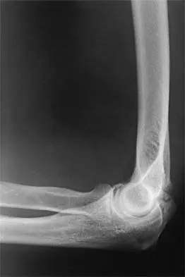 Orthopedic Surgery MCQs Set 1: Upper & Lower Limb Trauma, Spine Basics | AAOS, ABOS, SMLE 2026 Review