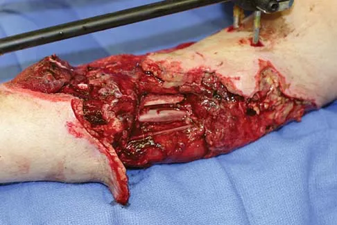 Orthopedic Surgery Board Review 2026 | High-Yield MCQs - Set 1 - Figure 21